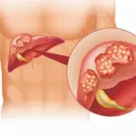 Liver cancer: ଯକୃତ କର୍କଟର ନିରାକରଣ ସମ୍ଭବ